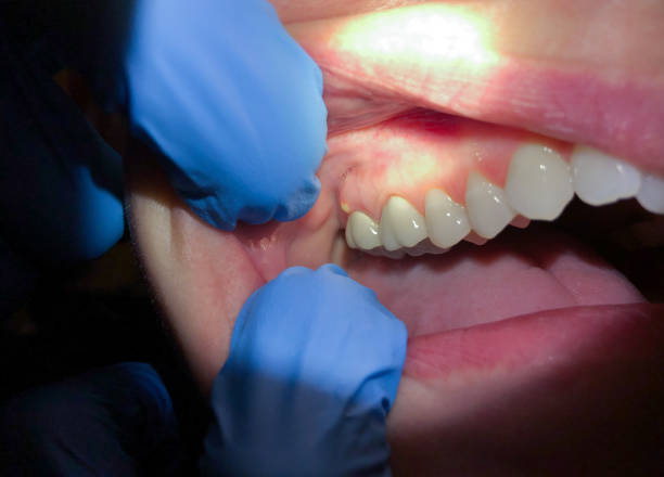 Best Emergency Wisdom Teeth Removal in Schnecksville, PA